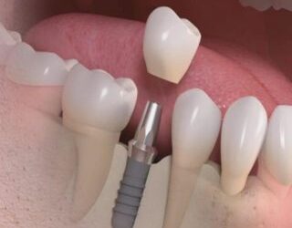أضرار تأخير تعويض الأسنان المفقودة وطرق التعويض