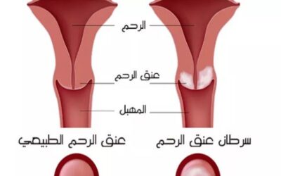 كل ما يهمك معرفته عن فايروس الورم الحليمي