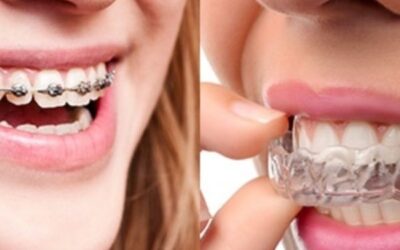 أيهما أختار: التقويم المعدني أم الشفاف؟