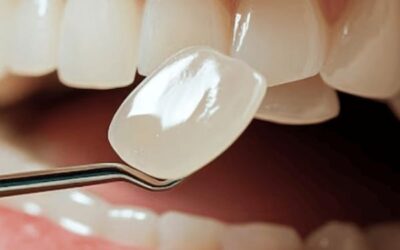 خطوات تركيب عدسات الأسنان المتوقعة في كل زيارة