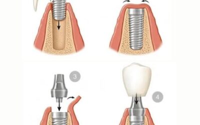 خطوات زراعة الأسنان المتوقعة في كل زيارة