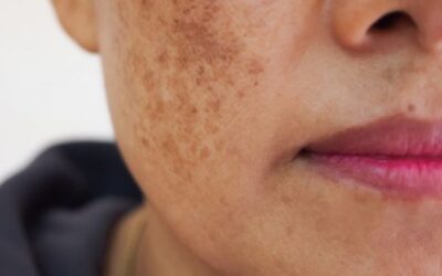 طرق علاج بقع الشمس والوقاية منها