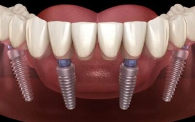 نصائح للحفاظ على زرعات الأسنان مدى الحياة