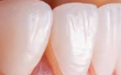 هل الفينير يضر الأسنان؟ إليك الحقائق الطبية